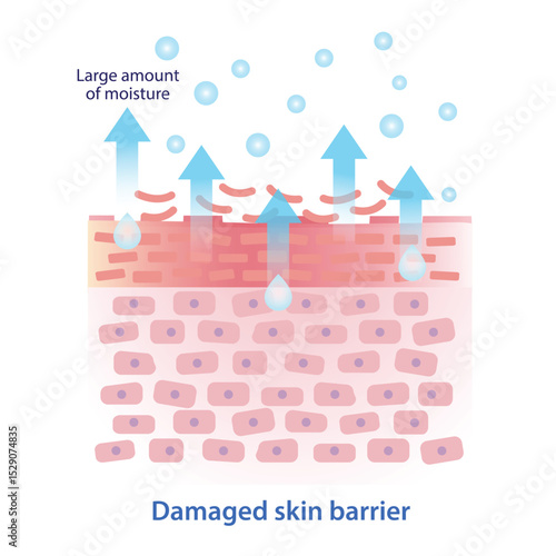 The state of damaged skin barrier illustration. The stratum corneum collapses, moisture evaporates from the skin surface. The amount of trans epidermal water loss, TEWL is large. Dry, red, rough skin.