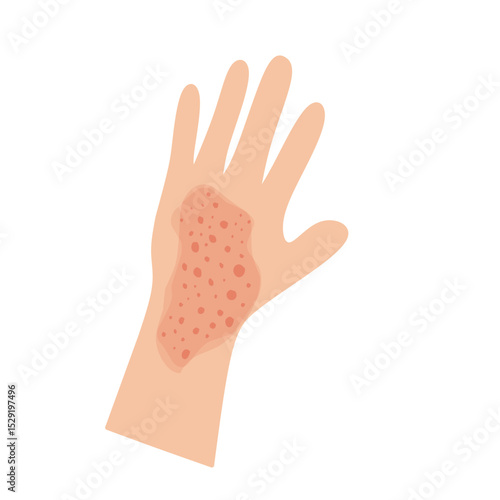 Illustration of a hand affected by allergies. Flat design illustration of a sick hand. Illustration of a hand with red bumps due to allergies