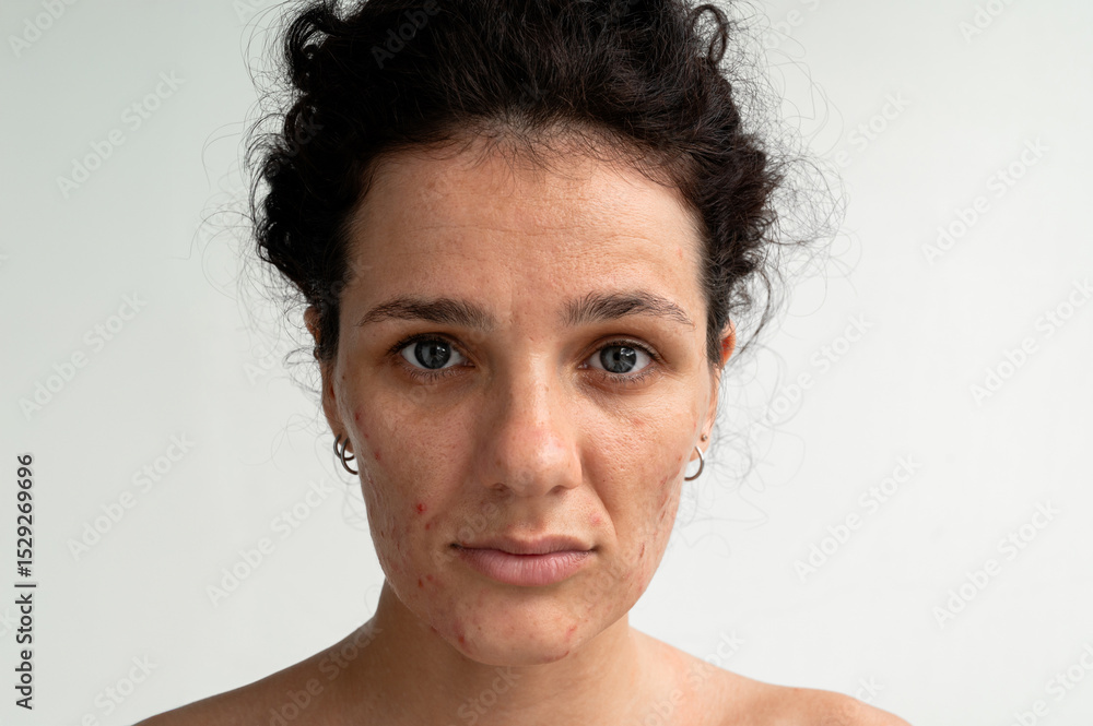 Naklejka premium Portrait of a young woman with skin texture with red pimples, irritation and clogged pores, which indicates dermatological problems with skin care. Hormonal acne and spots on the face.