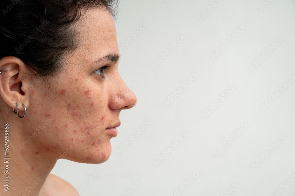 Fototapeta premium Close-up skin texture with red pimples, irritation and clogged pores, which indicates dermatological problems with skin care. Hormonal acne and spots on the face.