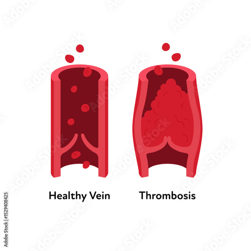 Deep vein thrombosis for healthcare infographic. Vector flat illustration. Vascular disease diagnostic and treatment. Human healthy vein and DVT . Design for health care, education