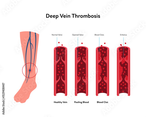 Deep vein thrombosis for healthcare infographic. Vector flat illustration. Vascular disease diagnostic and treatment. Human veins with DVT and blood clot. Design for health care, education
