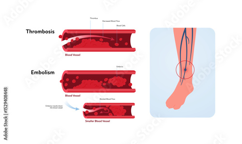 Deep vein thrombosis for healthcare infographic. Vector flat illustration. Vascular disease diagnostic and treatment. Human veins with DVT and blood clot. Design for health care, education