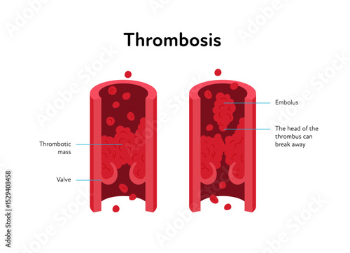 Deep vein thrombosis for healthcare infographic. Vector flat illustration with text label. Vascular disease diagnostic and treatment. Human healthy vein and DVT. Design for health care, education