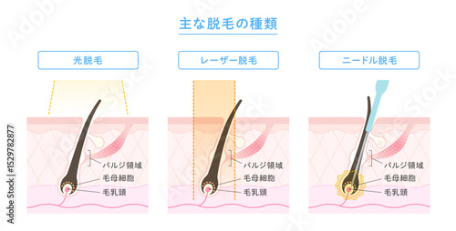 脱毛の種類 光脱毛・レーザー脱毛・ニードル脱毛