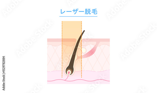 レーザー脱毛・医療脱毛のしくみ 断面図