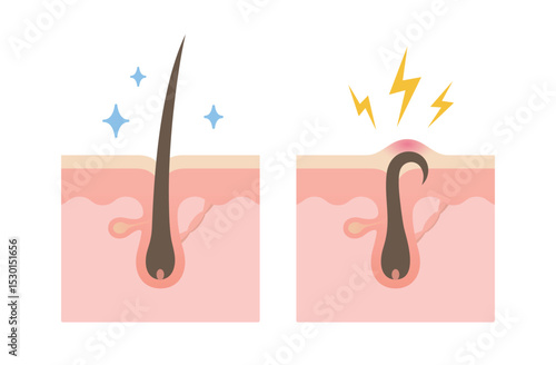 Normal and Ingrown hair. Structure of human hair follicle. Ingrown hair skin inflammation.