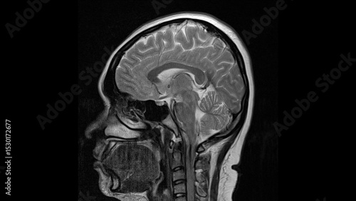 normal T2 sagital plane brain Magnetic resonance imaging (MRI)	