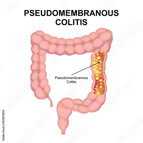 Pseudomembranous Colitis Illustration Human Colon