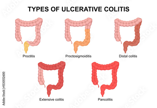 Types of Ulcerative Colitis Illustration