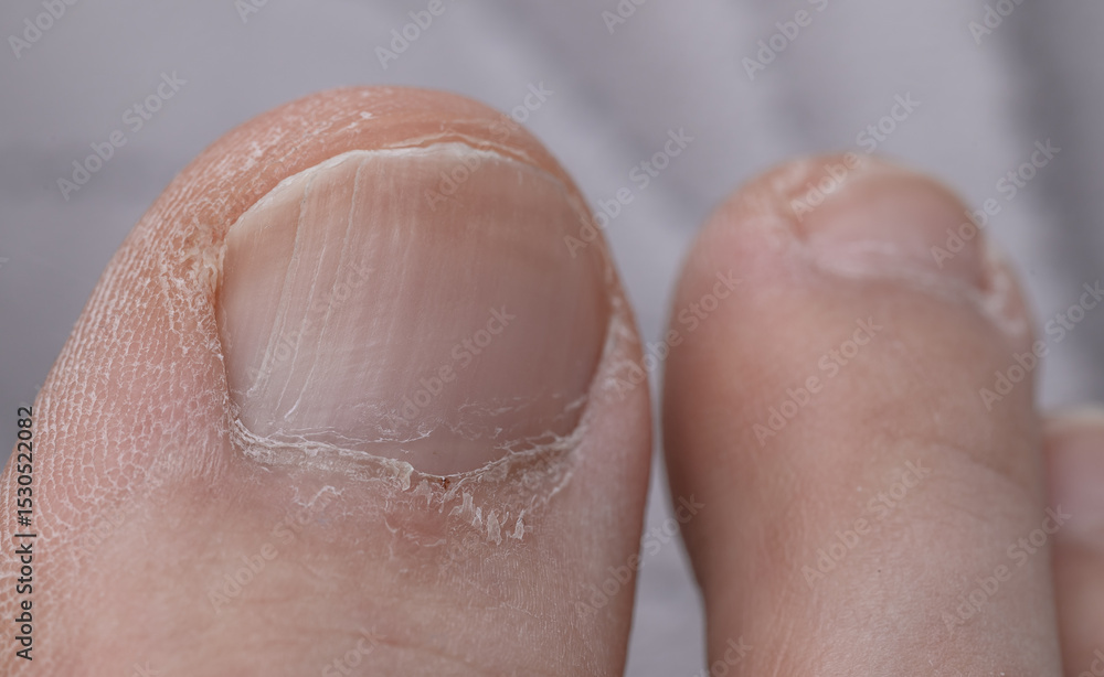Fototapeta premium Dry neglected toenail with transverse longitudinal fissures close up