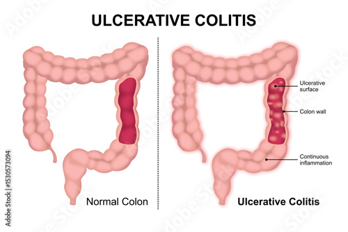 Ulcerative Colitis vs Normal Colon Illustration