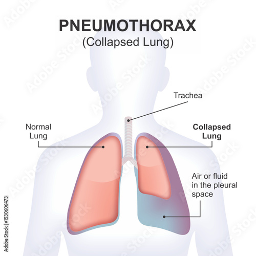 Pneumothorax (Collapsed Lung) Illustration 2D