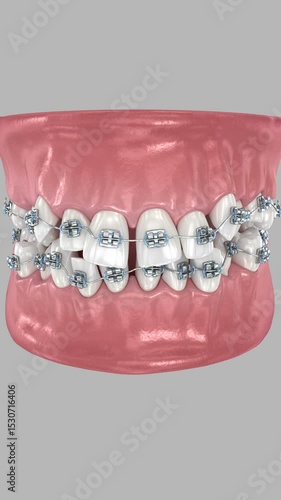 Abnormal teeth position and correction with braces. Dental 3D animation