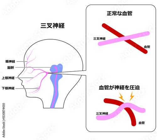 三叉神経痛