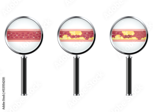 Progression of blocked artery viewed through magnifiers, showing plaque buildup and restricted blood flow. Prevention is key for health.