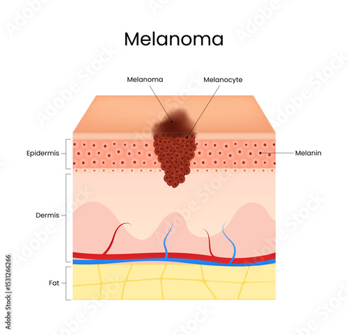 Melanoma Symptoms Diagram of Skin Cancer