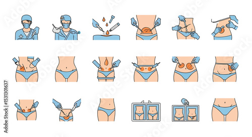 Vector icons Set of  Abdominal Procedures StepbyStep Illustrations of Liposuction. Vector Illustrations