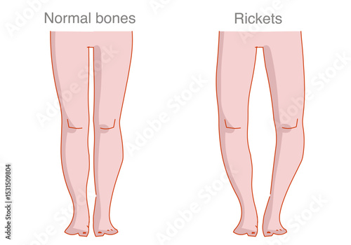 Rickets is the softening and weakening of bones in children .Vitamin D or calcium deficiency. Vector illustration.