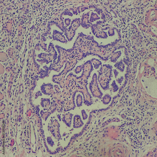 Camera photo of renal papillary adenoma, magnification 200x, photograph through a microscope