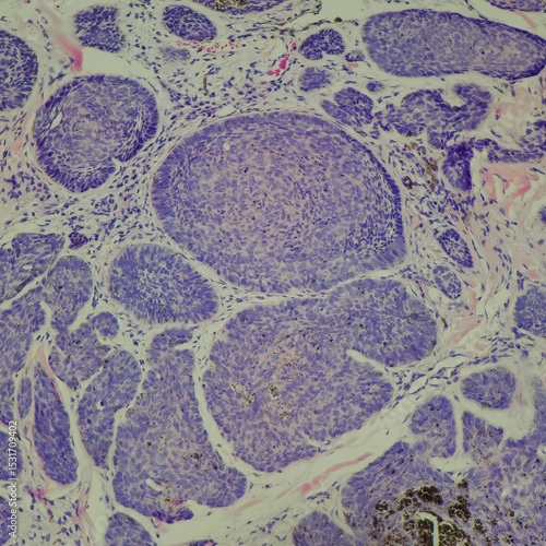 Camera photo of basal cell carcinoma, showing tumor sheet with peripheral nuclear palisading, magnification 200x, photograph through a microscope