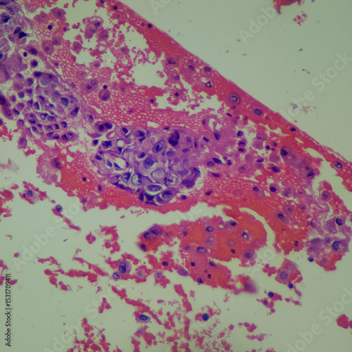 Camera photo of squamous cell carcinoma from fine needle aspiration, magnification 400x, photograph through a microscope