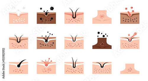 Vector Icons Set of Illustrated Skin Conditions Acne Blackheads and Hair Follicle Issues Depicted. Vector Illustrations
