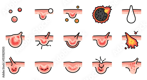 Vector Icons Set of Illustrated Stages of Acne Formation and Progression on Skin Surface. Vector Illustrations
