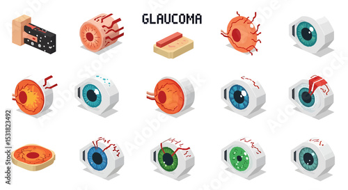 Vector Icons Set of Isometric Illustrations of Glaucoma Detailing Eye Anatomy and Disease Progression. Vector Illustrations