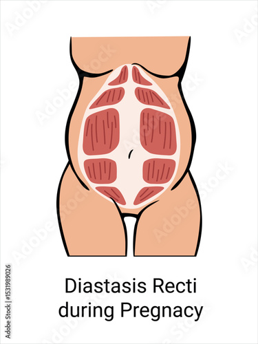 Diastasis Recti during pregnancy. The anatomy of a Woman. A woman's muscular corset during childbirth. Vector illustration
