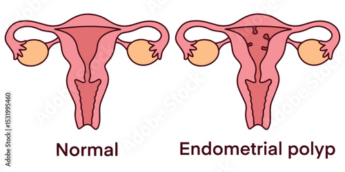 Side-by-side view of normal uterus and uterus with endometrial polyp. Educational tool for gynecology, diagnosis, and medical teaching