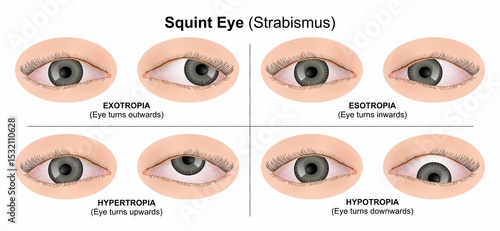 Squint Eye (Strabismus) Illustration eye