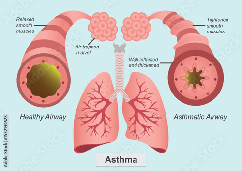 Asthma is a chronic condition that inflames and narrows the airways in the lungs.