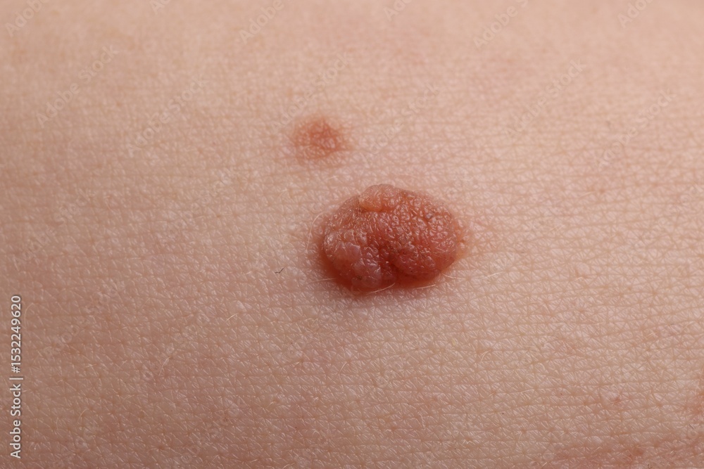 Fototapeta premium Woman with moles on her body, closeup