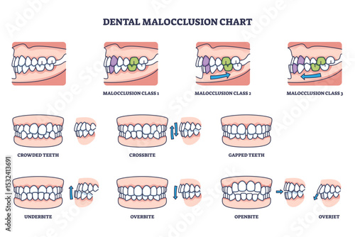 Dental malocclusion chart shows types of teeth misalignment, including overbite, underbite, and crossbite, transparent background.