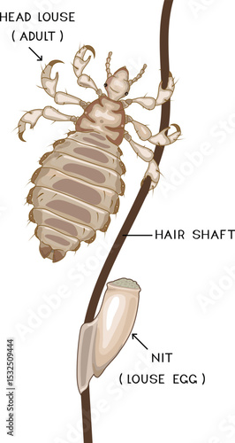 Male head louse (Pediculus humanus) insect and louse egg (nit) attached to hair for biology lesson