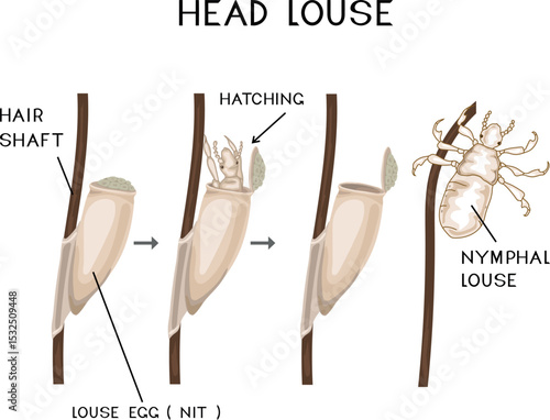 Structure of head louse egg (nit) attached to a hair and louse hatching for biology lesson