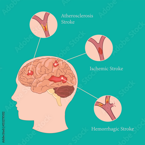 Brain stroke types illustration: atherosclerosis, ischemic, and hemorrhagic stroke in human brain.