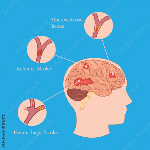 Human brain illustration showing types of stroke: ischemic, hemorrhagic, and atherosclerosis.