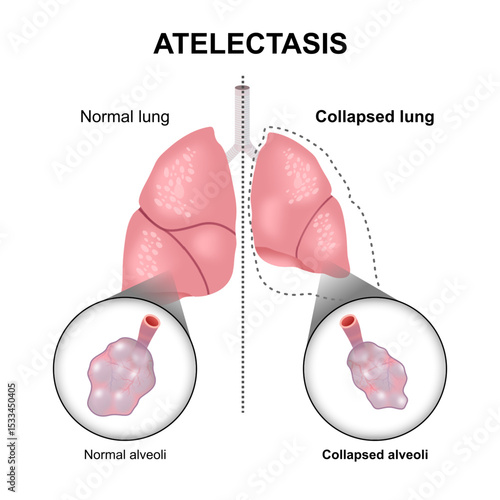 Atelectasis collaped lung and alveoli illustration