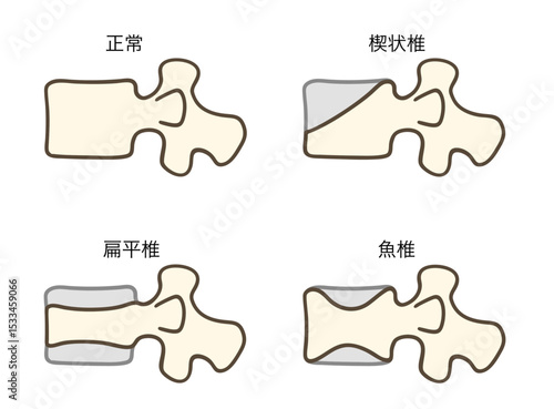 椎骨の形態比較、正常、楔状椎、魚椎、扁平椎のイラスト2
