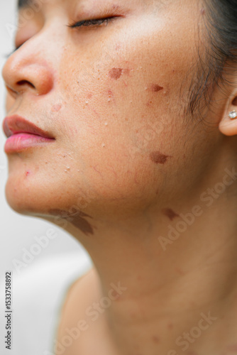 Portrait of an Asian woman with skin burn marks of brown spots on her face and neck