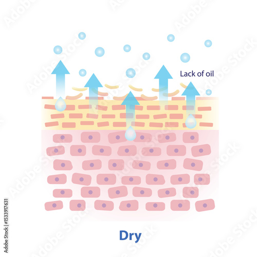 The mechanism of dry skin vector illustration isolated on white background. Cross section of lack of natural oil on skin layer causes more trans epidermal water loss. Skin care and beauty concept.