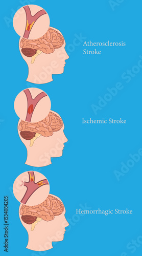 Stroke classification visual: artery blockage, clot, and bleeding inside the brain