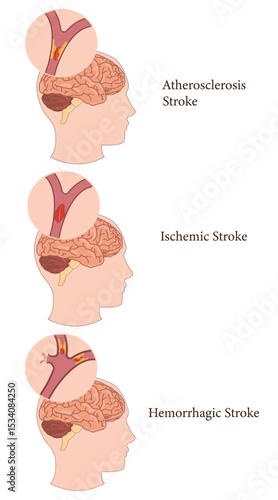 Medical diagram showing different stroke types and their brain impact locations