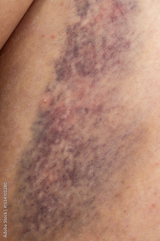 Fototapeta premium A person's arm has a bruise on it