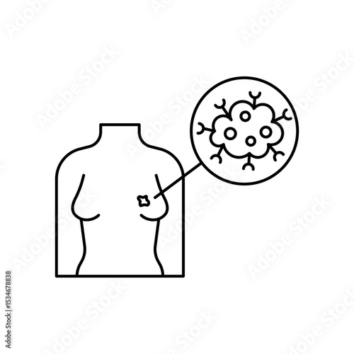 Breast Cancer
