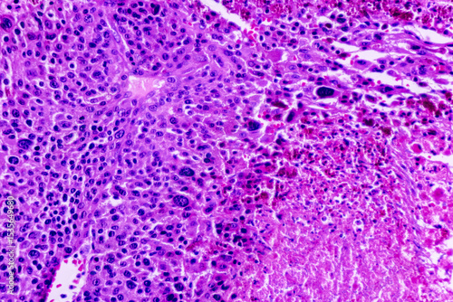 Image of human cells tissue of lung human under the microscope in pathology lab.View in microscopic of squamous cell carcinoma from human cervical cancer, tissue section by H and E