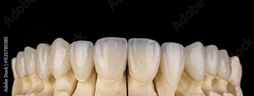 ceramic crowns and veneers