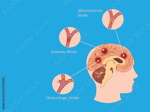 Medical illustration of atherosclerosis, ischemic, and hemorrhagic stroke in the brain